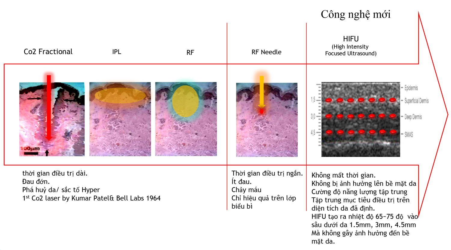 cong nghe hifu ultraformer 3 vuot troi
